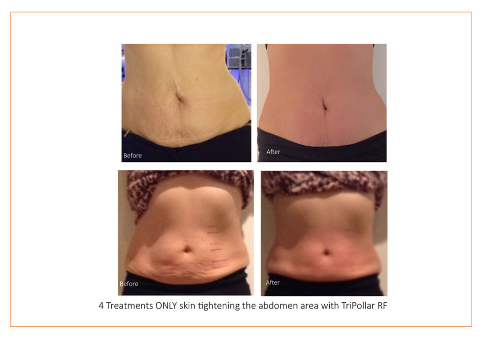 Lipofirm The Beauty Rooms Horsham